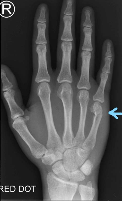 hand boxer metal|boxer's fracture in hand.